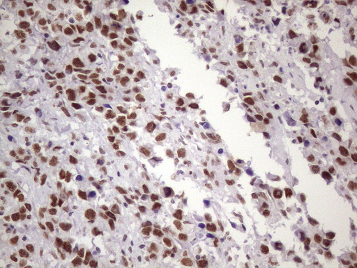NUDT21 Antibody - Immunohistochemical staining of paraffin-embedded Adenocarcinoma of Human ovary tissue using anti-NUDT21 mouse monoclonal antibody. (Heat-induced epitope retrieval by 1 mM EDTA in 10mM Tris, pH8.5, 120C for 3min. (1:150)