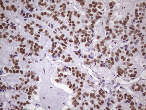 NUDT21 Antibody - Immunohistochemical staining of paraffin-embedded Carcinoma of Human pancreas tissue using anti-NUDT21 mouse monoclonal antibody. (Heat-induced epitope retrieval by 1 mM EDTA in 10mM Tris, pH8.5, 120C for 3min. (1:150)