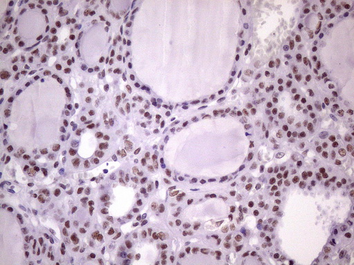 NUDT21 Antibody - Immunohistochemical staining of paraffin-embedded Carcinoma of Human thyroid tissue using anti-NUDT21 mouse monoclonal antibody. (Heat-induced epitope retrieval by 1 mM EDTA in 10mM Tris, pH8.5, 120C for 3min. (1:150)