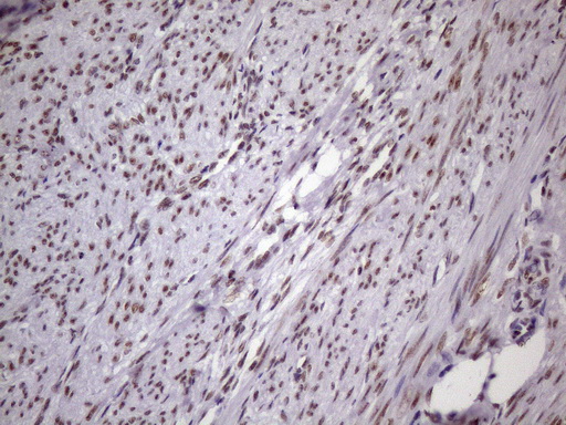 NUDT21 Antibody - Immunohistochemical staining of paraffin-embedded Human endometrium tissue within the normal limits using anti-NUDT21 mouse monoclonal antibody. (Heat-induced epitope retrieval by 1 mM EDTA in 10mM Tris, pH8.5, 120C for 3min. (1:150)