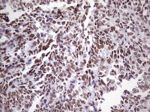 NUDT21 Antibody - Immunohistochemical staining of paraffin-embedded Adenocarcinoma of Human endometrium tissue using anti-NUDT21 mouse monoclonal antibody. (Heat-induced epitope retrieval by 1 mM EDTA in 10mM Tris, pH8.5, 120C for 3min. (1:150)