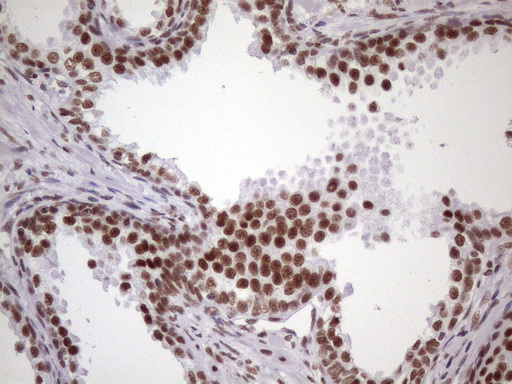 NUDT21 Antibody - Immunohistochemical staining of paraffin-embedded Human prostate tissue within the normal limits using anti-NUDT21 mouse monoclonal antibody. (Heat-induced epitope retrieval by 1 mM EDTA in 10mM Tris, pH8.5, 120C for 3min. (1:150)