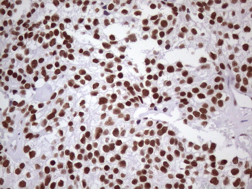 NUDT21 Antibody - Immunohistochemical staining of paraffin-embedded Adenocarcinoma of Human breast tissue using anti-NUDT21 mouse monoclonal antibody. (Heat-induced epitope retrieval by 1 mM EDTA in 10mM Tris, pH8.5, 120C for 3min. (1:150)