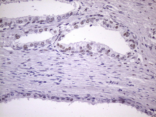 NUDT21 Antibody - Immunohistochemical staining of paraffin-embedded Carcinoma of Human prostate tissue using anti-NUDT21 mouse monoclonal antibody. (Heat-induced epitope retrieval by 1 mM EDTA in 10mM Tris, pH8.5, 120C for 3min. (1:150)