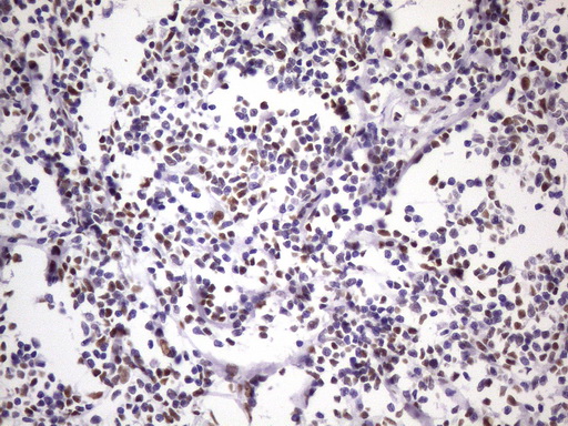 NUDT21 Antibody - Immunohistochemical staining of paraffin-embedded Human lymphoma tissue using anti-NUDT21 mouse monoclonal antibody. (Heat-induced epitope retrieval by 1 mM EDTA in 10mM Tris, pH8.5, 120C for 3min. (1:150)