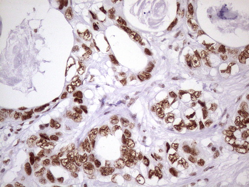 NUDT21 Antibody - Immunohistochemical staining of paraffin-embedded Adenocarcinoma of Human colon tissue using anti-NUDT21 mouse monoclonal antibody. (Heat-induced epitope retrieval by 1 mM EDTA in 10mM Tris, pH8.5, 120C for 3min. (1:150)