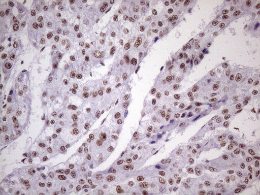 NUDT21 Antibody - Immunohistochemical staining of paraffin-embedded Carcinoma of Human liver tissue using anti-NUDT21 mouse monoclonal antibody. (Heat-induced epitope retrieval by 1 mM EDTA in 10mM Tris, pH8.5, 120C for 3min. (1:150)