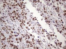 NUDT21 Antibody - IHC of paraffin-embedded Adenocarcinoma of Human ovary tissue using anti-NUDT21 mouse monoclonal antibody. (Heat-induced epitope retrieval by 1 mM EDTA in 10mM Tris, pH8.5, 120°C for 3min)(1:150).