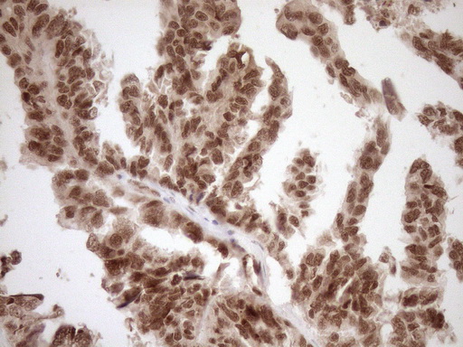NUDT21 Antibody - Immunohistochemical staining of paraffin-embedded Adenocarcinoma of Human ovary tissue using anti-NUDT21 mouse monoclonal antibody. (Heat-induced epitope retrieval by 1mM EDTA in 10mM Tris buffer. (pH8.5) at 120°C for 3 min. (1:150)