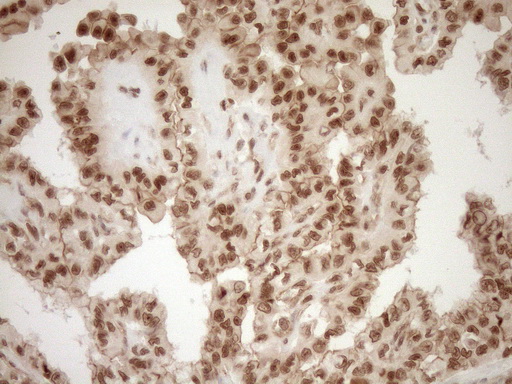 NUDT21 Antibody - Immunohistochemical staining of paraffin-embedded Carcinoma of Human thyroid tissue using anti-NUDT21 mouse monoclonal antibody. (Heat-induced epitope retrieval by 1mM EDTA in 10mM Tris buffer. (pH8.5) at 120°C for 3 min. (1:150)