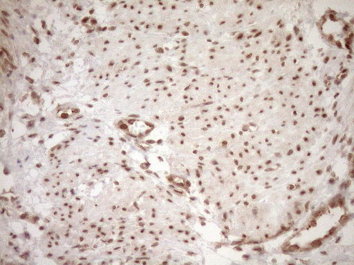 NUDT21 Antibody - Immunohistochemical staining of paraffin-embedded Human endometrium tissue within the normal limits using anti-NUDT21 mouse monoclonal antibody. (Heat-induced epitope retrieval by 1mM EDTA in 10mM Tris buffer. (pH8.5) at 120°C for 3 min. (1:150)