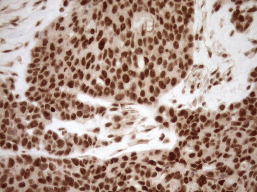 NUDT21 Antibody - Immunohistochemical staining of paraffin-embedded Adenocarcinoma of Human endometrium tissue using anti-NUDT21 mouse monoclonal antibody. (Heat-induced epitope retrieval by 1mM EDTA in 10mM Tris buffer. (pH8.5) at 120°C for 3 min. (1:150)