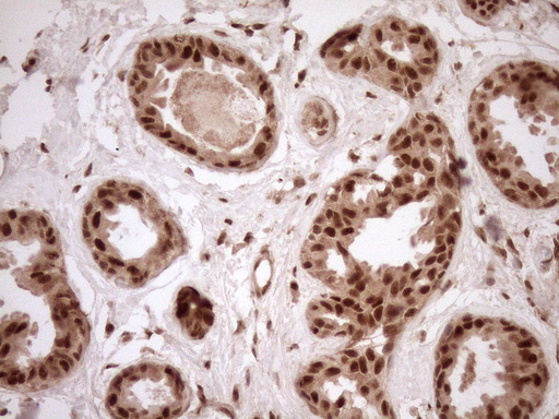 NUDT21 Antibody - Immunohistochemical staining of paraffin-embedded Adenocarcinoma of Human breast tissue using anti-NUDT21 mouse monoclonal antibody. (Heat-induced epitope retrieval by 1mM EDTA in 10mM Tris buffer. (pH8.5) at 120°C for 3 min. (1:150)