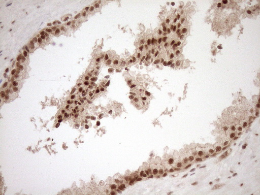 NUDT21 Antibody - Immunohistochemical staining of paraffin-embedded Carcinoma of Human prostate tissue using anti-NUDT21 mouse monoclonal antibody. (Heat-induced epitope retrieval by 1mM EDTA in 10mM Tris buffer. (pH8.5) at 120°C for 3 min. (1:150)