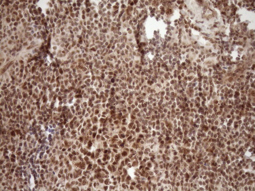 NUDT21 Antibody - Immunohistochemical staining of paraffin-embedded Human tonsil within the normal limits using anti-NUDT21 mouse monoclonal antibody. (Heat-induced epitope retrieval by 1mM EDTA in 10mM Tris buffer. (pH8.5) at 120°C for 3 min. (1:150)