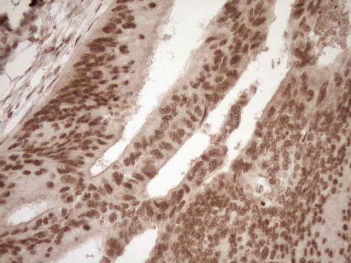 NUDT21 Antibody - Immunohistochemical staining of paraffin-embedded Adenocarcinoma of Human colon tissue using anti-NUDT21 mouse monoclonal antibody. (Heat-induced epitope retrieval by 1mM EDTA in 10mM Tris buffer. (pH8.5) at 120°C for 3 min. (1:150)