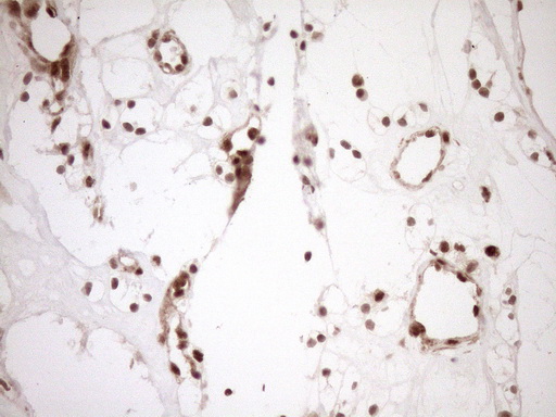 NUDT21 Antibody - Immunohistochemical staining of paraffin-embedded Carcinoma of Human kidney tissue using anti-NUDT21 mouse monoclonal antibody. (Heat-induced epitope retrieval by 1mM EDTA in 10mM Tris buffer. (pH8.5) at 120°C for 3 min. (1:150)