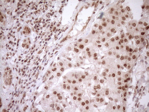 NUDT21 Antibody - Immunohistochemical staining of paraffin-embedded Carcinoma of Human liver tissue using anti-NUDT21 mouse monoclonal antibody. (Heat-induced epitope retrieval by 1mM EDTA in 10mM Tris buffer. (pH8.5) at 120°C for 3 min. (1:150)