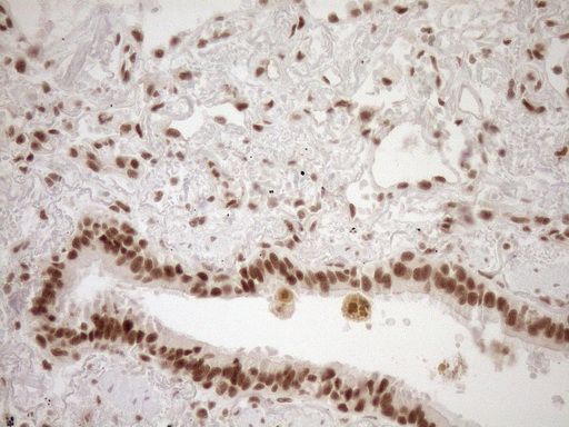 NUDT21 Antibody - Immunohistochemical staining of paraffin-embedded Carcinoma of Human lung tissue using anti-NUDT21 mouse monoclonal antibody. (Heat-induced epitope retrieval by 1mM EDTA in 10mM Tris buffer. (pH8.5) at 120°C for 3 min. (1:150)