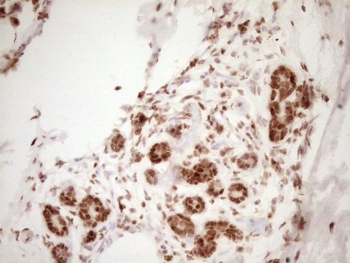 NUDT21 Antibody - Immunohistochemical staining of paraffin-embedded Human breast tissue within the normal limits using anti-NUDT21 mouse monoclonal antibody. (Heat-induced epitope retrieval by 1 mM EDTA in 10mM Tris, pH8.5, 120C for 3min,