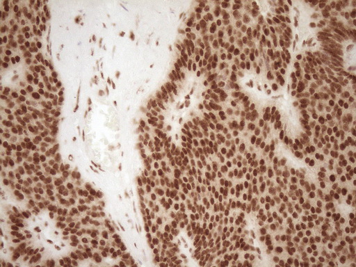 NUDT21 Antibody - Immunohistochemical staining of paraffin-embedded Carcinoma of Human lung tissue using anti-NUDT21 mouse monoclonal antibody. (Heat-induced epitope retrieval by 1 mM EDTA in 10mM Tris, pH8.5, 120C for 3min,