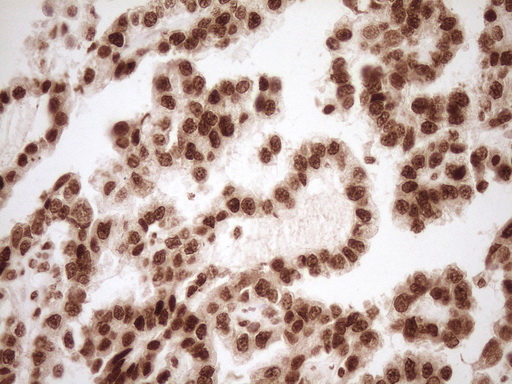 NUDT21 Antibody - Immunohistochemical staining of paraffin-embedded Adenocarcinoma of Human ovary tissue using anti-NUDT21 mouse monoclonal antibody. (Heat-induced epitope retrieval by 1 mM EDTA in 10mM Tris, pH8.5, 120C for 3min,
