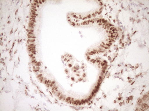 NUDT21 Antibody - Immunohistochemical staining of paraffin-embedded Carcinoma of Human pancreas tissue using anti-NUDT21 mouse monoclonal antibody. (Heat-induced epitope retrieval by 1 mM EDTA in 10mM Tris, pH8.5, 120C for 3min,