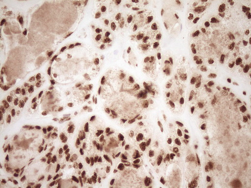 NUDT21 Antibody - Immunohistochemical staining of paraffin-embedded Carcinoma of Human thyroid tissue using anti-NUDT21 mouse monoclonal antibody. (Heat-induced epitope retrieval by 1 mM EDTA in 10mM Tris, pH8.5, 120C for 3min,