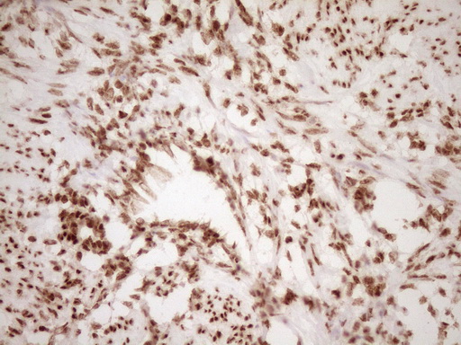 NUDT21 Antibody - Immunohistochemical staining of paraffin-embedded Human endometrium tissue within the normal limits using anti-NUDT21 mouse monoclonal antibody. (Heat-induced epitope retrieval by 1 mM EDTA in 10mM Tris, pH8.5, 120C for 3min,