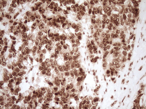 NUDT21 Antibody - Immunohistochemical staining of paraffin-embedded Adenocarcinoma of Human endometrium tissue using anti-NUDT21 mouse monoclonal antibody. (Heat-induced epitope retrieval by 1 mM EDTA in 10mM Tris, pH8.5, 120C for 3min,