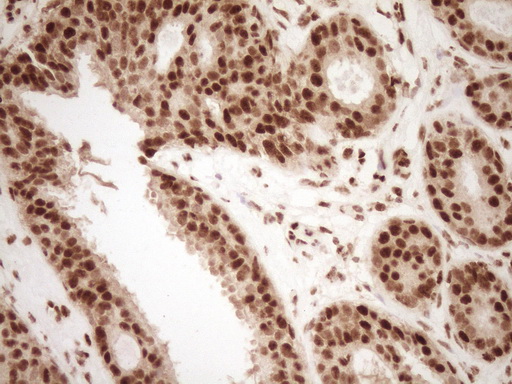 NUDT21 Antibody - Immunohistochemical staining of paraffin-embedded Adenocarcinoma of Human breast tissue using anti-NUDT21 mouse monoclonal antibody. (Heat-induced epitope retrieval by 1 mM EDTA in 10mM Tris, pH8.5, 120C for 3min,