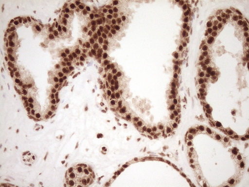 NUDT21 Antibody - Immunohistochemical staining of paraffin-embedded Carcinoma of Human prostate tissue using anti-NUDT21 mouse monoclonal antibody. (Heat-induced epitope retrieval by 1 mM EDTA in 10mM Tris, pH8.5, 120C for 3min,