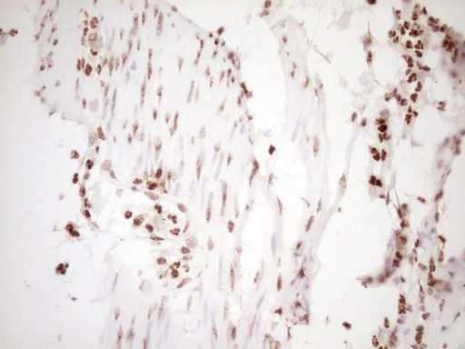 NUDT21 Antibody - Immunohistochemical staining of paraffin-embedded Human bladder tissue within the normal limits using anti-NUDT21 mouse monoclonal antibody. (Heat-induced epitope retrieval by 1 mM EDTA in 10mM Tris, pH8.5, 120C for 3min,