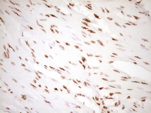 NUDT21 Antibody - Immunohistochemical staining of paraffin-embedded Carcinoma of Human bladder tissue using anti-NUDT21 mouse monoclonal antibody. (Heat-induced epitope retrieval by 1 mM EDTA in 10mM Tris, pH8.5, 120C for 3min,