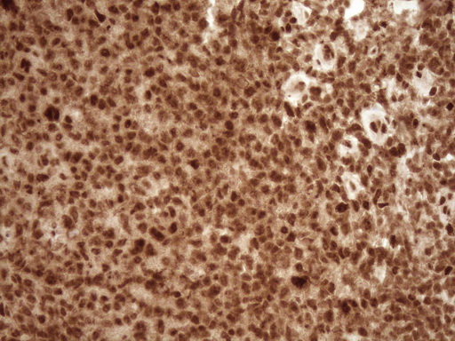 NUDT21 Antibody - Immunohistochemical staining of paraffin-embedded Human lymph node tissue within the normal limits using anti-NUDT21 mouse monoclonal antibody. (Heat-induced epitope retrieval by 1 mM EDTA in 10mM Tris, pH8.5, 120C for 3min,