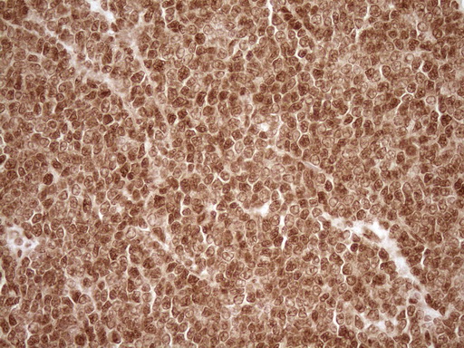 NUDT21 Antibody - Immunohistochemical staining of paraffin-embedded Human lymphoma tissue using anti-NUDT21 mouse monoclonal antibody. (Heat-induced epitope retrieval by 1 mM EDTA in 10mM Tris, pH8.5, 120C for 3min,