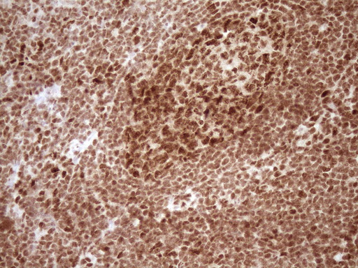 NUDT21 Antibody - Immunohistochemical staining of paraffin-embedded Human tonsil within the normal limits using anti-NUDT21 mouse monoclonal antibody. (Heat-induced epitope retrieval by 1 mM EDTA in 10mM Tris, pH8.5, 120C for 3min,
