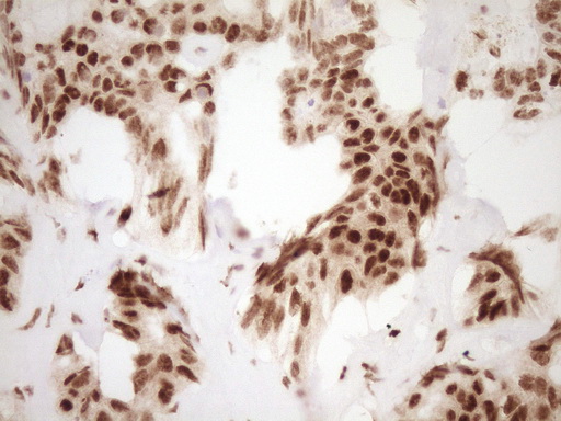 NUDT21 Antibody - Immunohistochemical staining of paraffin-embedded Carcinoma of Human liver tissue using anti-NUDT21 mouse monoclonal antibody. (Heat-induced epitope retrieval by 1 mM EDTA in 10mM Tris, pH8.5, 120C for 3min,