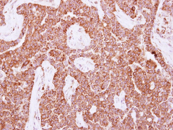NUDT3 Antibody - IHC of paraffin-embedded Lung AdCA, using NUDT3 antibody at 1:500 dilution.
