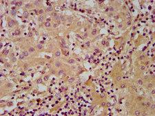 NUDT5 Antibody - Immunohistochemistry image at a dilution of 1:600 and staining in paraffin-embedded human liver cancer performed on a Leica BondTM system. After dewaxing and hydration, antigen retrieval was mediated by high pressure in a citrate buffer (pH 6.0) . Section was blocked with 10% normal goat serum 30min at RT. Then primary antibody (1% BSA) was incubated at 4 °C overnight. The primary is detected by a biotinylated secondary antibody and visualized using an HRP conjugated SP system.