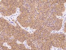 NUDT5 Antibody - Immunochemical staining of human NUDT5 in human bladder carcinoma with rabbit polyclonal antibody at 1:300 dilution, formalin-fixed paraffin embedded sections.