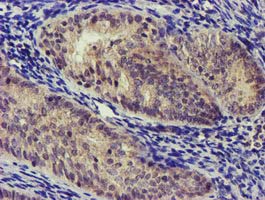 NUDT6 Antibody - IHC of paraffin-embedded Adenocarcinoma of Human endometrium tissue using anti-NUDT6 mouse monoclonal antibody.