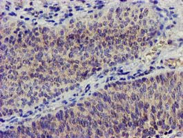 NUDT6 Antibody - IHC of paraffin-embedded Carcinoma of Human bladder tissue using anti-NUDT6 mouse monoclonal antibody.