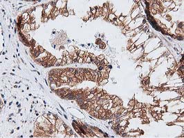 NUDT6 Antibody - IHC of paraffin-embedded Adenocarcinoma of Human ovary tissue using anti-NUDT6 mouse monoclonal antibody.