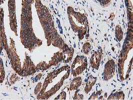 NUDT6 Antibody - IHC of paraffin-embedded Carcinoma of Human prostate tissue using anti-NUDT6 mouse monoclonal antibody.