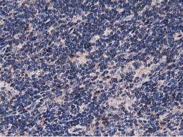 NUDT6 Antibody - IHC of paraffin-embedded Human lymphoma tissue using anti-NUDT6 mouse monoclonal antibody.