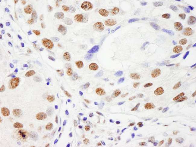 NUMA1 / NUMA Antibody - Detection of Human NUMA by Immunohistochemistry. Sample: FFPE section of human breast carcinoma. Antibody: Affinity purified rabbit anti-NUMA used at a dilution of 1:200 (1 ug/ml). Detection: DAB.