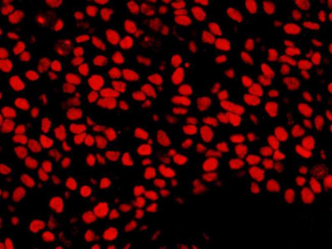 NUMA1 / NUMA Antibody - Detection of Human NUMA by Immunofluorescence. Sample: FFPE section of human breast carcinoma. Antibody: Affinity purified rabbit anti-NUMA used at a dilution of 1:400 (0.5 ug/ml). Detection: Red-fluorescent Goat anti-Rabbit IgG-heavy and light chain cross-adsorbed Antibody DyLight 594 Conjugated (A120-601D4) used at a dilution of 1:100.