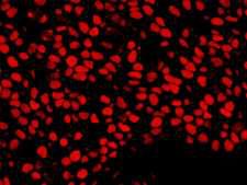 NUMA1 / NUMA Antibody - Detection of Human NUMA by Immunofluorescence. Sample: FFPE section of human breast carcinoma. Antibody: Affinity purified rabbit anti-NUMA used at a dilution of 1:400 (0.5 ug/ml). Detection: Red-fluorescent Goat anti-Rabbit IgG-heavy and light chain cross-adsorbed Antibody DyLight 594 Conjugated (A120-601D4) used at a dilution of 1:100.