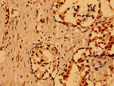 NUMA1 / NUMA Antibody - Immunohistochemistry image of paraffin-embedded human breast cancer at a dilution of 1:100